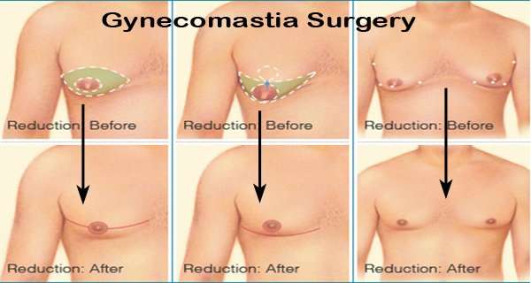 Gynecomastia surgery in Navi Mumbai