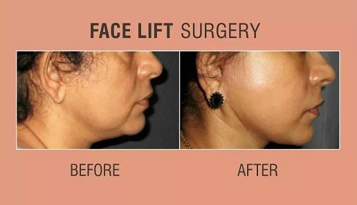 Facelift Surgery in Mumbai