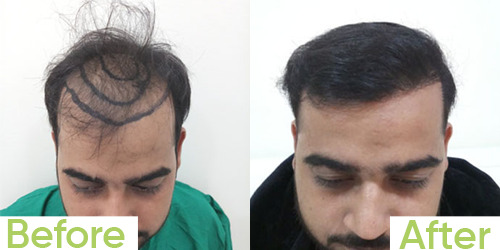 Results of Hair Transplants