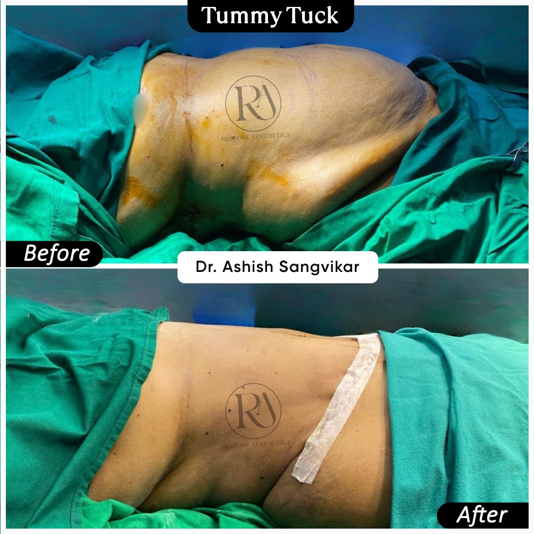 Tummy Tuck Before After Result 1