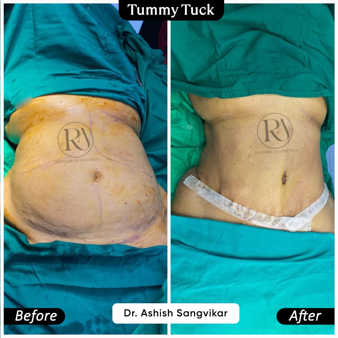 Tummy Tuck Before After Result 2