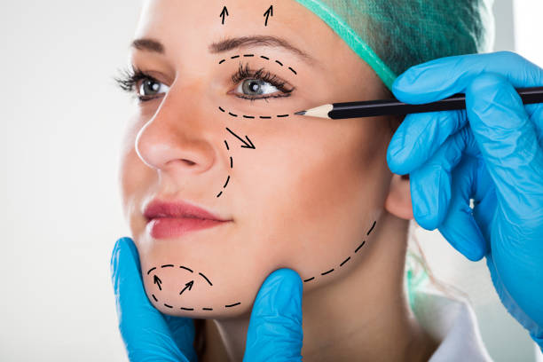 What is Facelift Surgery