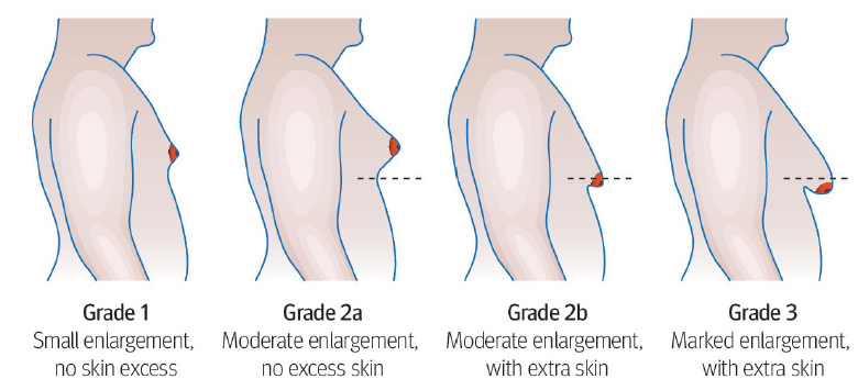 Grades of Gynecomastia